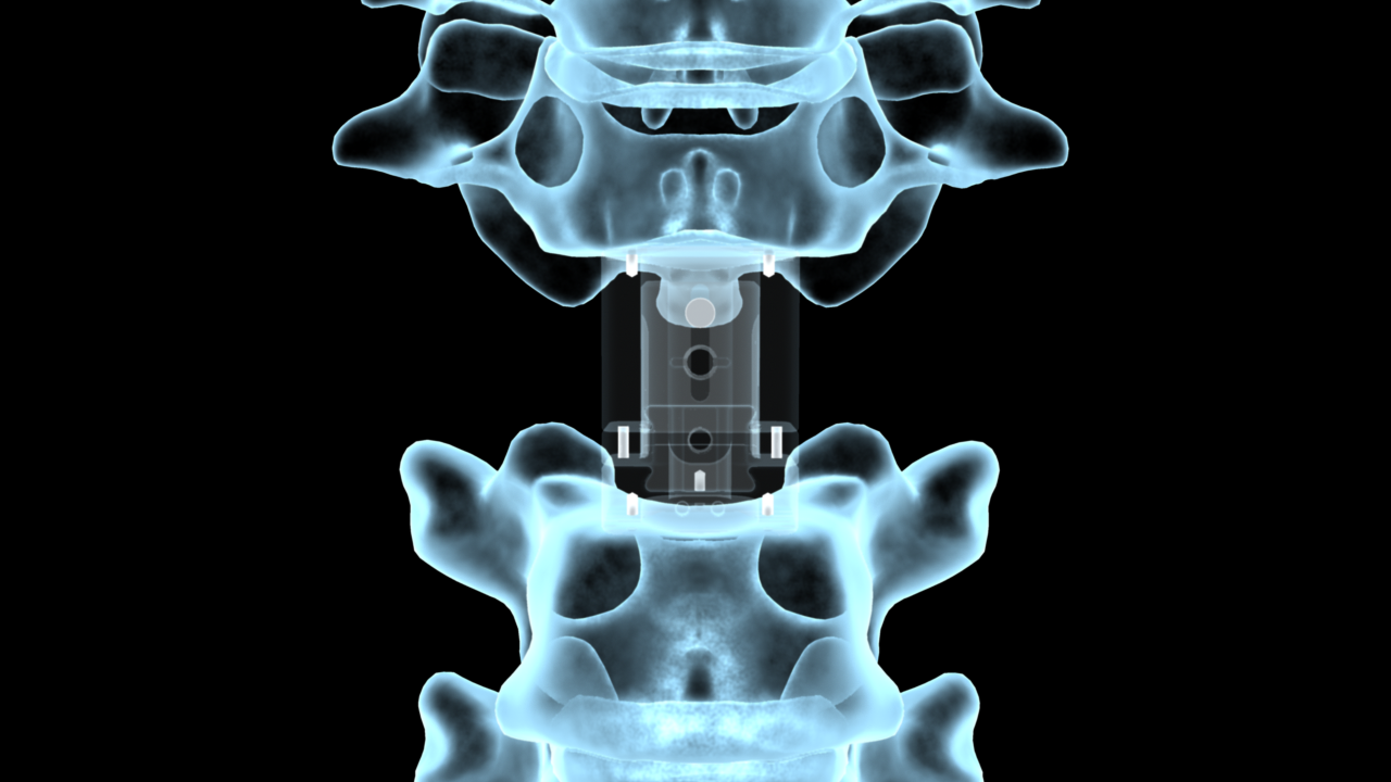 Corpectomy Device X-ray